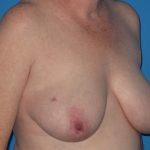 Breast Reduction Before & After Patient #2102