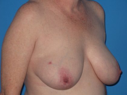 Breast Reduction Before & After Patient #2102