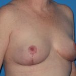 Breast Reduction Before & After Patient #2102