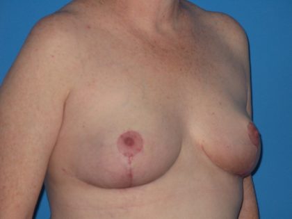Breast Reduction Before & After Patient #2102