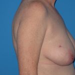 Breast Reduction Before & After Patient #2102