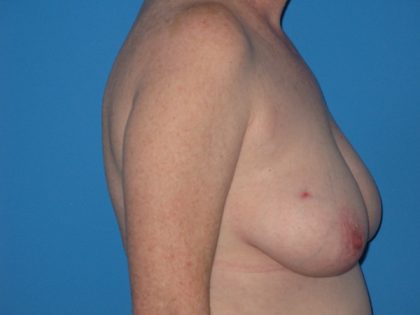 Breast Reduction Before & After Patient #2102