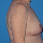 Breast Reduction Before & After Patient #2102