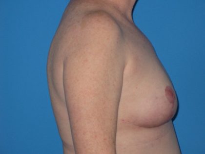 Breast Reduction Before & After Patient #2102