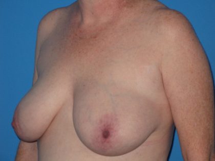 Breast Reduction Before & After Patient #2102