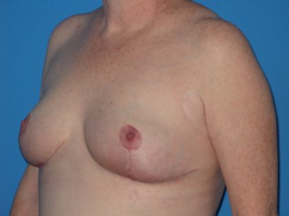 Breast Reduction Before & After Patient #2102