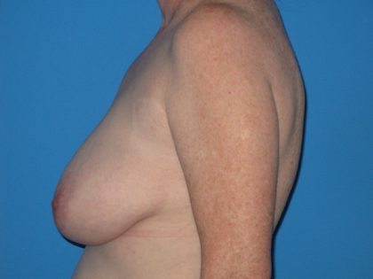 Breast Reduction Before & After Patient #2102