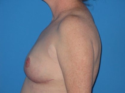 Breast Reduction Before & After Patient #2102