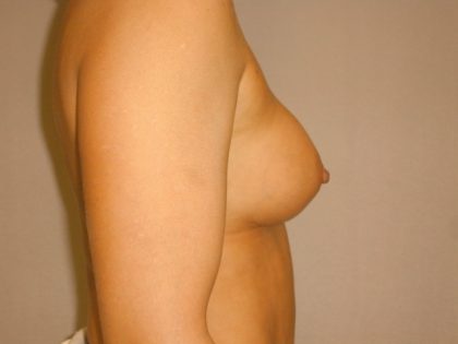 Implant Exchange Before & After Patient #1807
