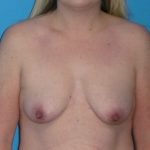 Breast Augmentation Before & After Patient #1657