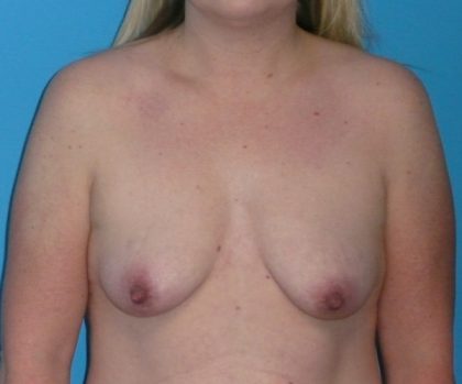 Breast Augmentation Before & After Patient #1657