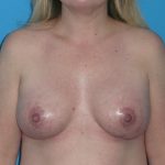 Breast Augmentation Before & After Patient #1657
