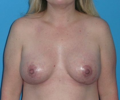 Breast Augmentation Before & After Patient #1657