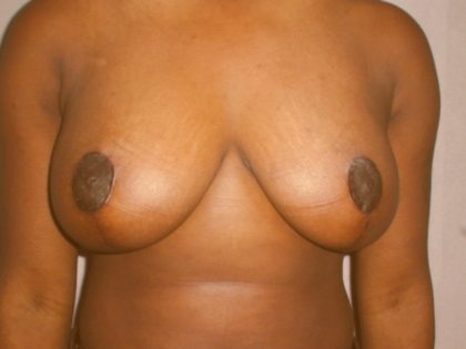 Breast Reduction Before & After Patient #2113