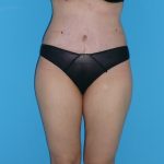 Tummy Tuck Before & After Patient #2172
