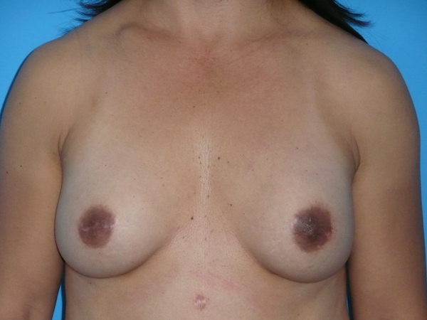 Implant Exchange Before & After Patient #1818