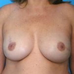 Breast Reconstruction Before & After Patient #1872