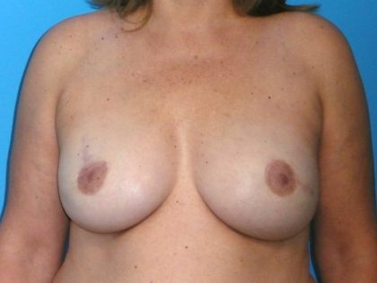 Breast Reconstruction Before & After Patient #1872