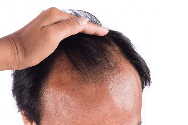 Best PRP Hair Restoration Baltimore, Maryland | Valley Plastic Surgery & Medspa Best PRP Hair Restoration Baltimore, Maryland | Valley Plastic Surgery & Medspa